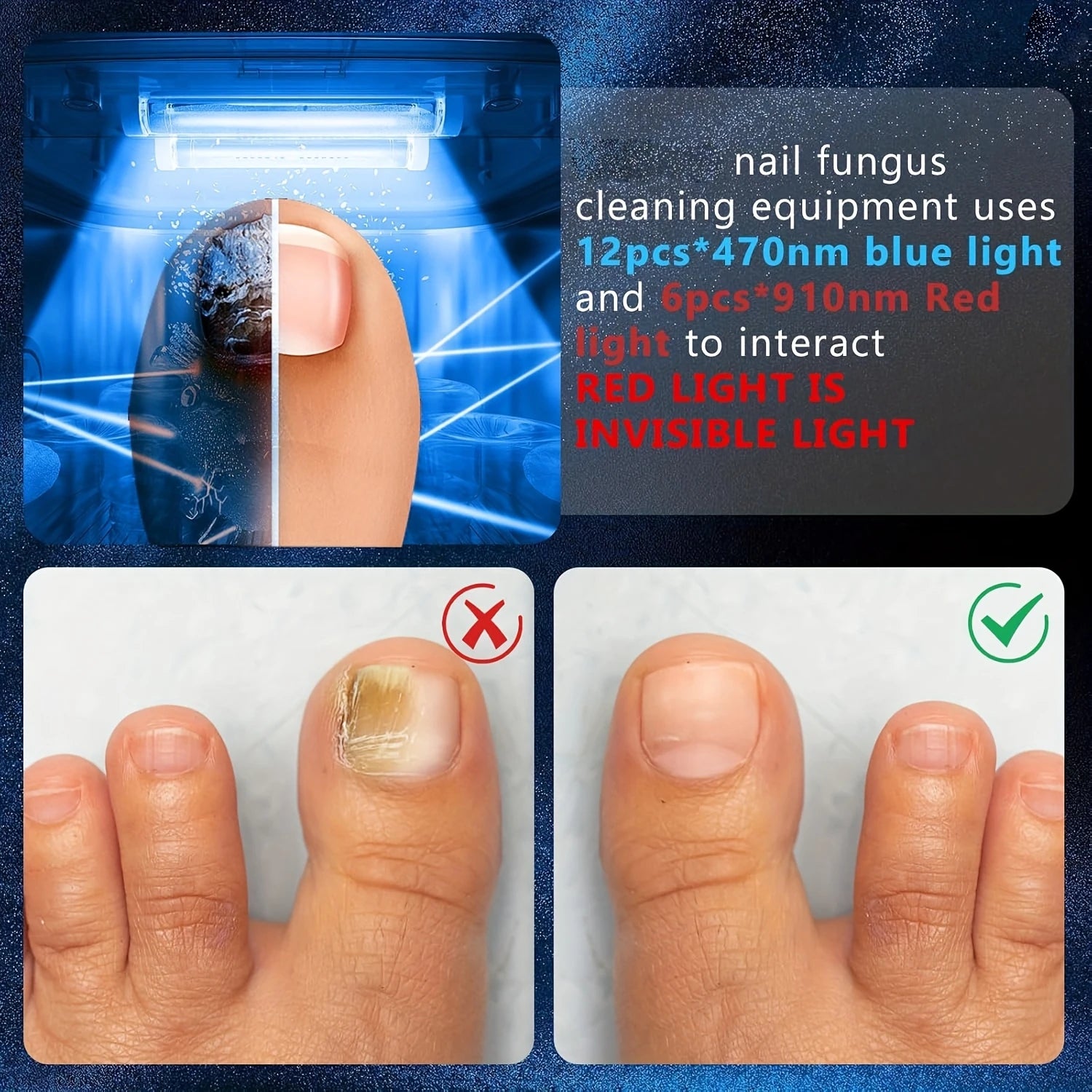 Wireless Nail Fungus Laser Device for Toenails Onychomycosis Infrared Light 470Nm 910Nm Blue Light anti Fungal Laser Equipment