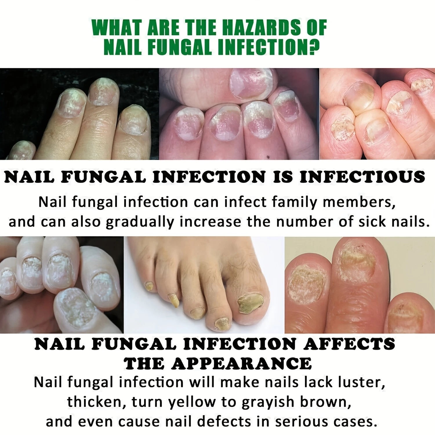 Wireless Nail Fungus Laser Device for Toenails Onychomycosis Infrared Light 470Nm 910Nm Blue Light anti Fungal Laser Equipment